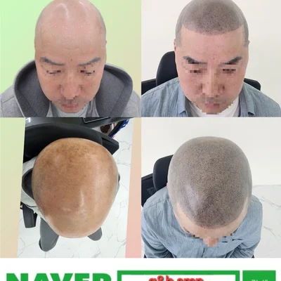 G&b SMP 두피문신