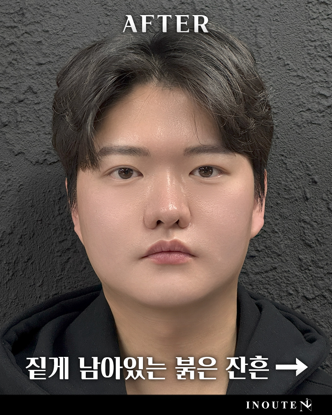반영구세안 다섯 번째 작품 예시
