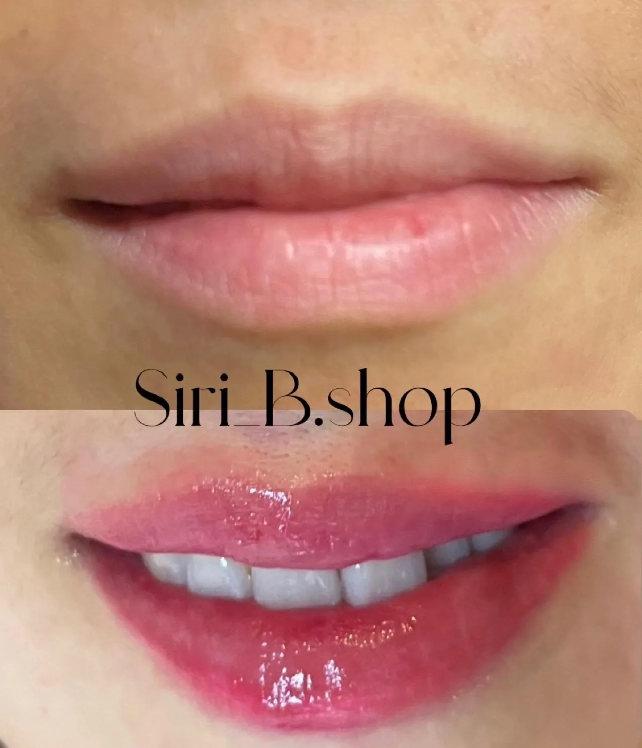 합리적 선택을 위한 실질적 조언 관련 입술 시술 예시
