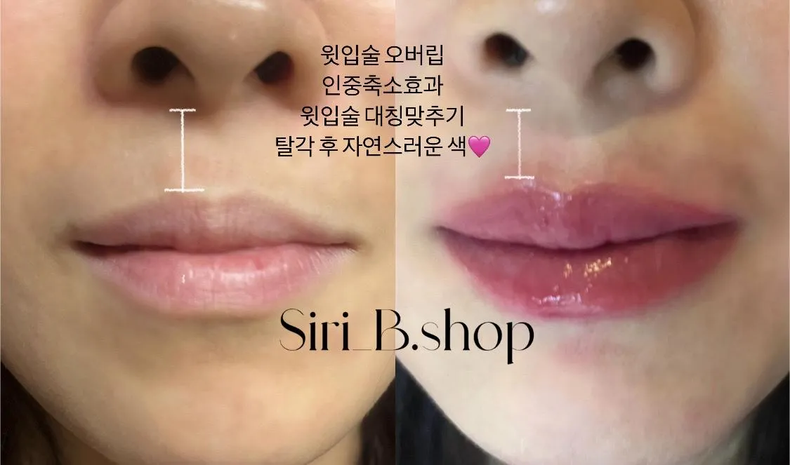 건강과 안전을 위한 법적 고려 사항 관련 입술 시술 예시