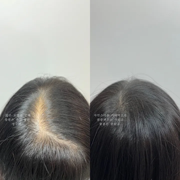 피부 타입에 따른 헤어라인 교정 비용의 차이 관련 헤어라인 시술 예시