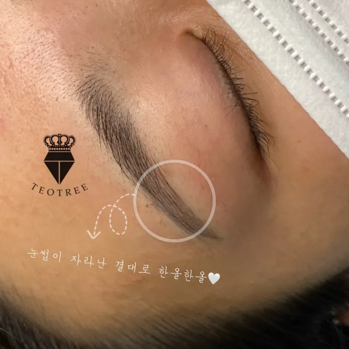 헤어라인 반영구 시술의 기초 관련 헤어라인 시술 예시