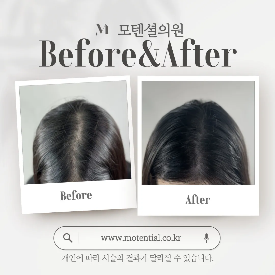 SMP와 유사 시술 비교 관련 헤어라인 시술 예시