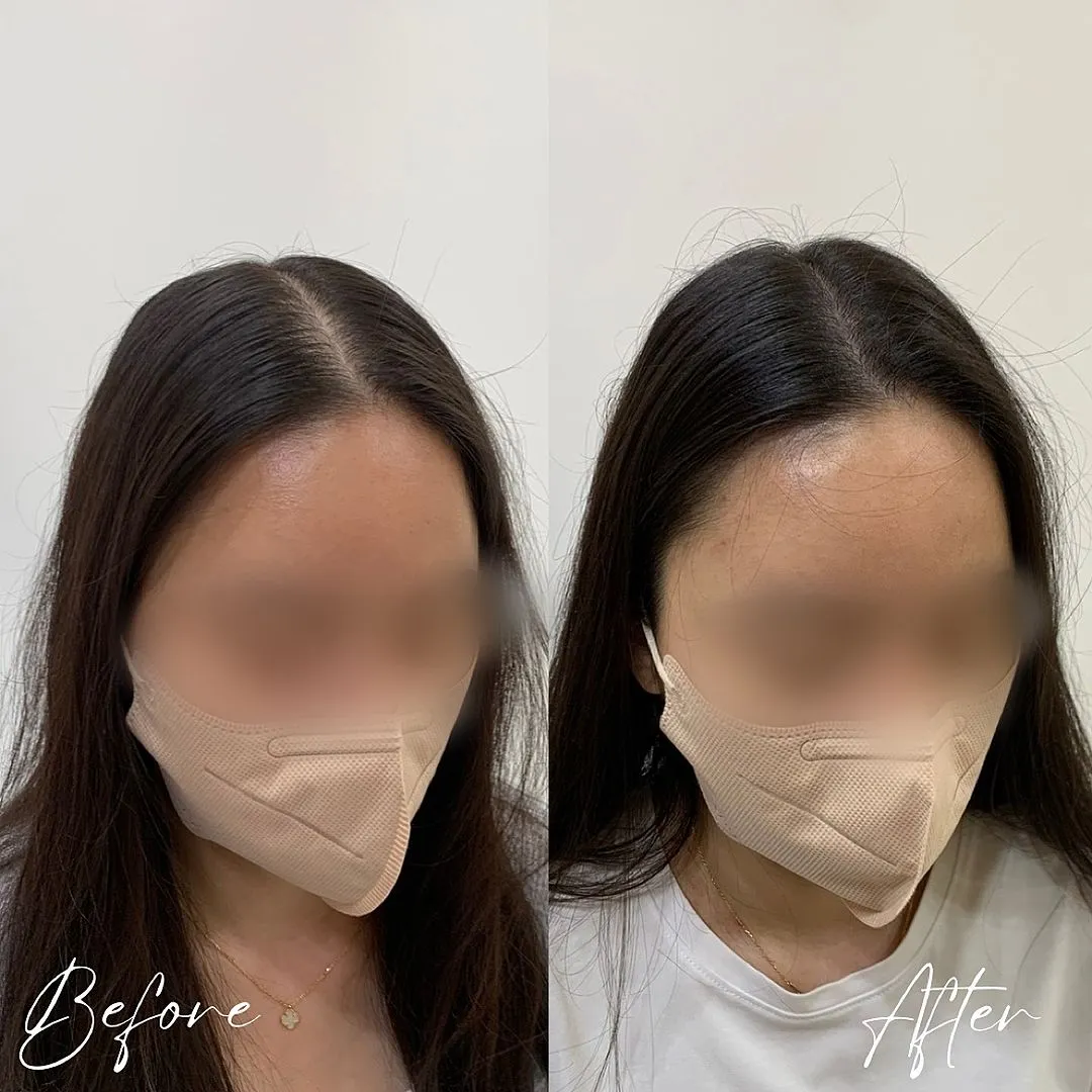 헤어라인 교정의 안전성 및 주의사항 관련 헤어라인 시술 예시