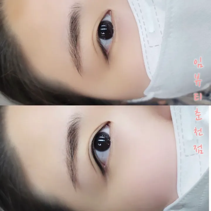시술 실패 사례 분석: 문제점과 개선 방안 관련 아이라인 시술 예시